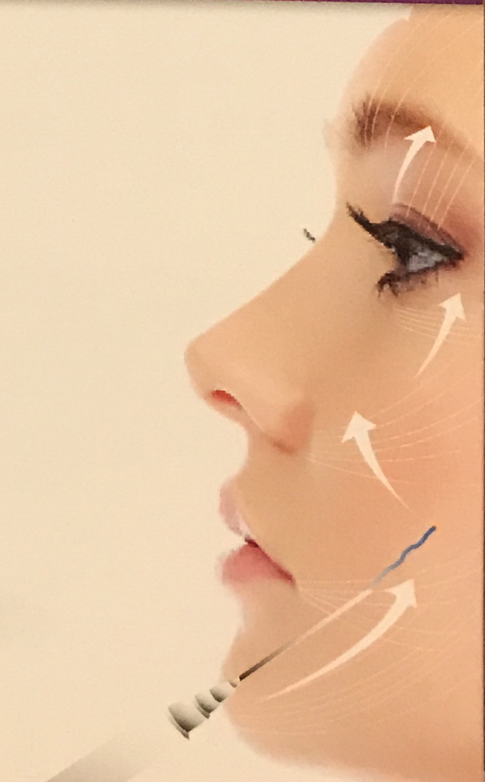 ร้อยไหมละลาย-ปรับรูปหน้า