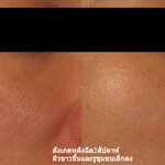ฟิลเลอร์เพื่อคุณภาพผิว
