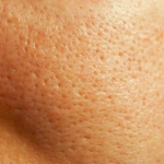 รูขุมขนกว้าง(Enlarged Pores)