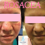 โรซาเซีย(Rosacea and Related Disorders)