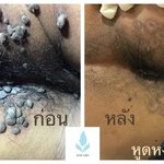 ไวรัสHPV(Human Papilloma Virus)