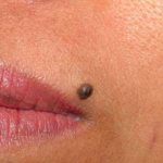 ไฝ หรือ อาจไม่ใช่ไฝ(มะเร็ง)